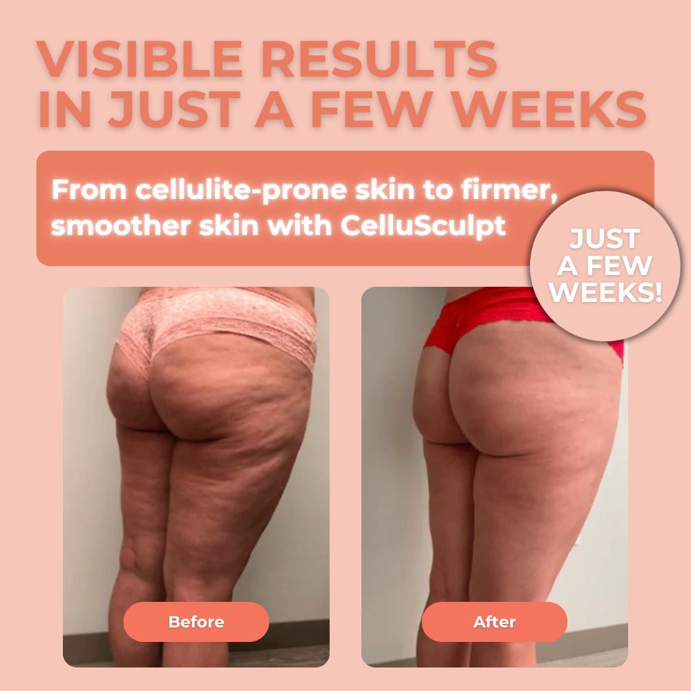 CelluSculpt 3.0 – Spring Sale Bundle
